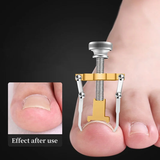 Ingrown Toenail Corrector