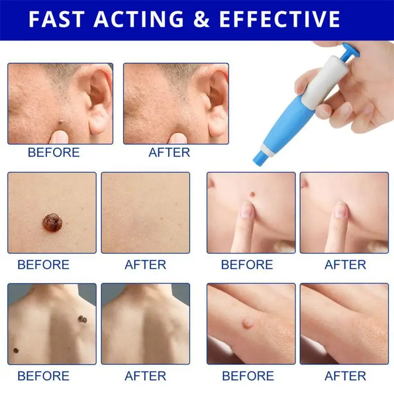 Painless Auto Skin Tag Mole Removal Kit