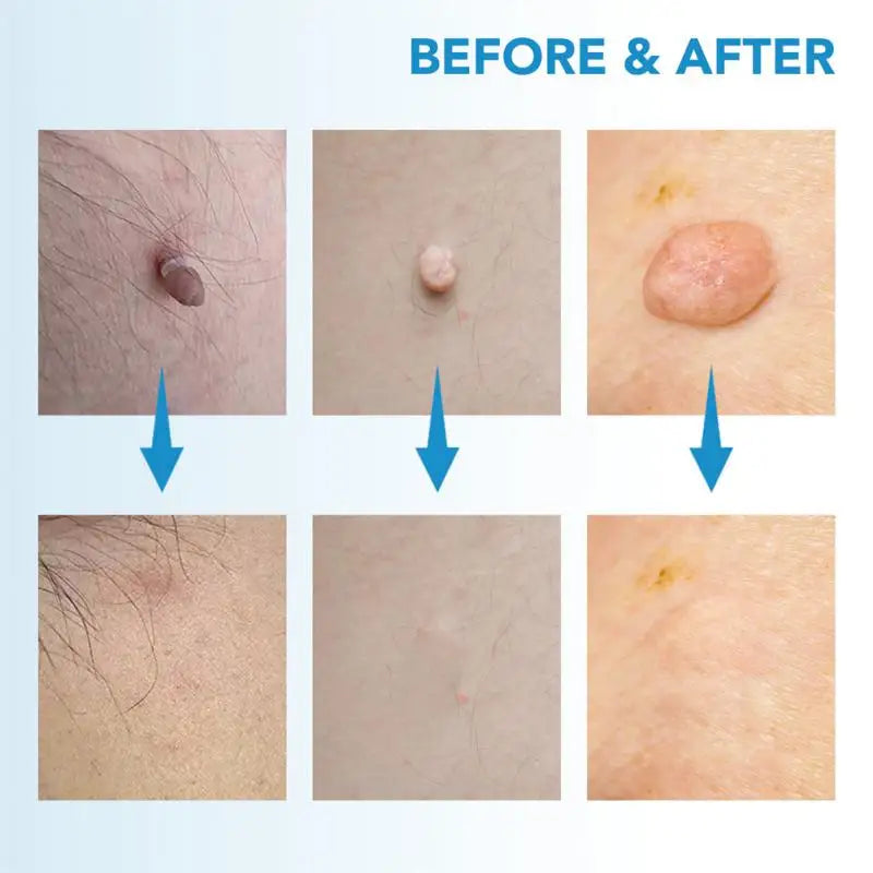 Painless Auto Skin Tag Mole Removal Kit