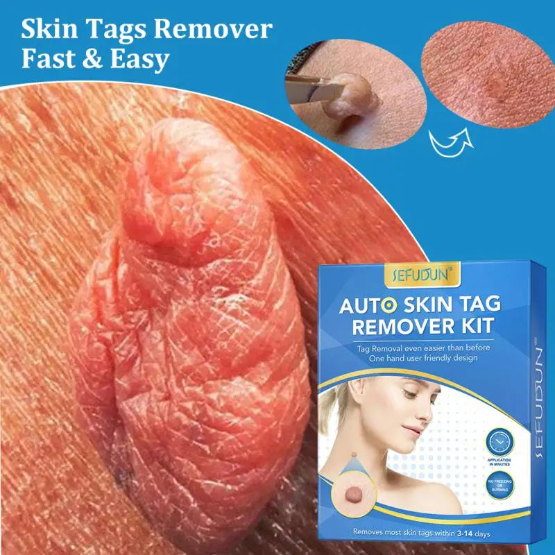 Painless Auto Skin Tag Mole Removal Kit