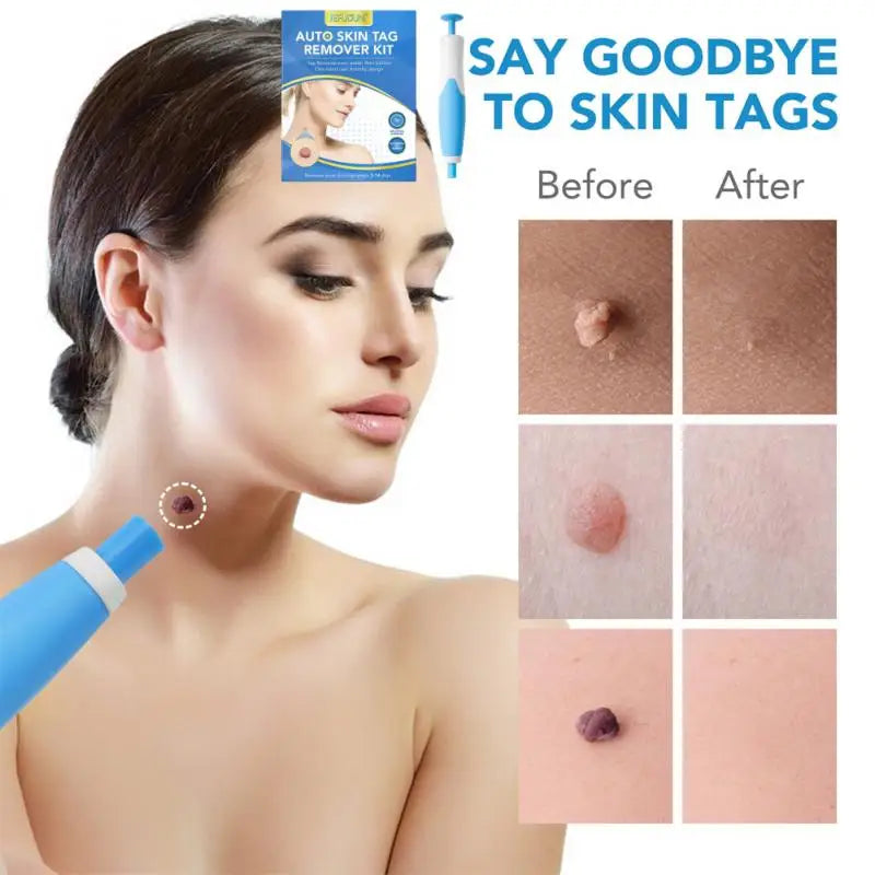 Painless Auto Skin Tag Mole Removal Kit